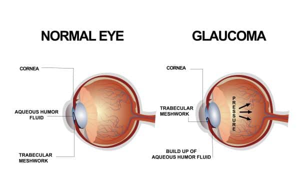 Imagem do globo ocular normal e imagem do globo ocular com glaucoma. 
Conceito de glaucoma congênito.