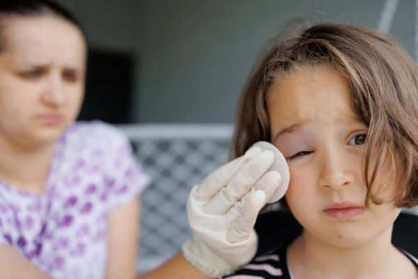 Garotinha com expressão de incômodo ocular devido ao olho inchado e vermelho. Médica oftalmologista realiza a limpeza do olhinho direito. 