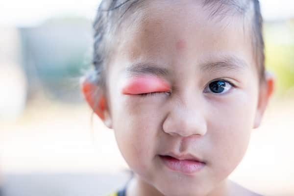 Menina asiática com a pálpebra do olho direito bastante inchada e vermelha.