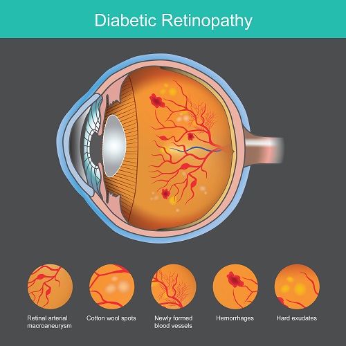 Infográfico da Retinopatia Diabética