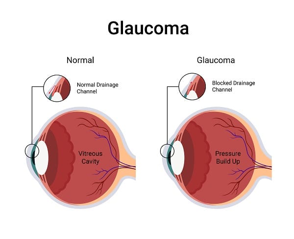 Gráfico representativo de um globo ocular normal e um outro com glaucoma. Esta é uma das condições que podem se desenvolver por quem tem diabetes mellitus.