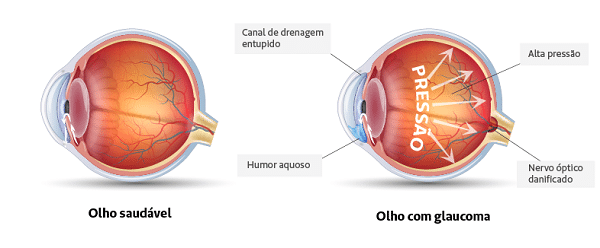 Vetores representativos de um globo ocular saudável e outro com glaucoma.