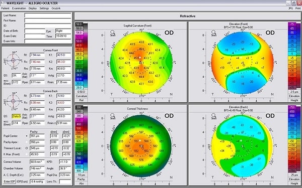 Imagem do mapeamento corneal.