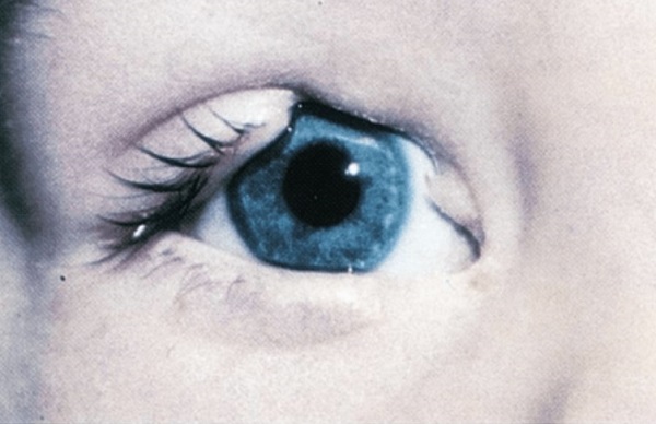 Coloboma de pálpebra em criança.