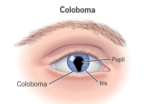 Imagem ilustrada de um olho humano com coloboma de íris.