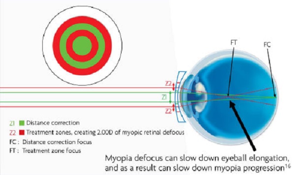 Quadro ilustrativo sobre como as lentes de contato MiSight agem sobre o globo ocular.